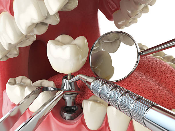 Best Lost Filling or Crown Replacement in Woodville, WI